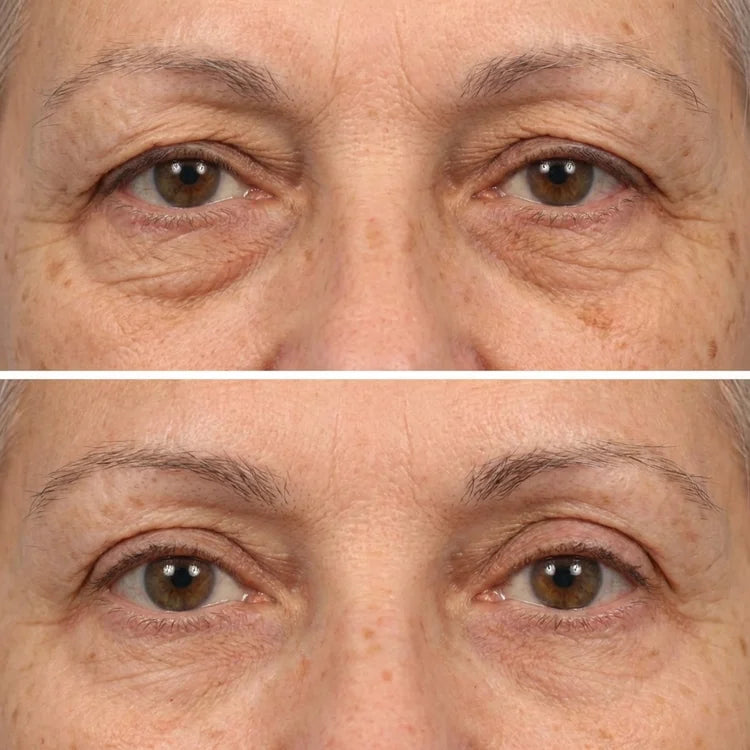 Tensor instantáneo que desinflama bolsas y camufla ojeras