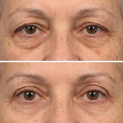 Tensor instantáneo que desinflama bolsas y camufla ojeras