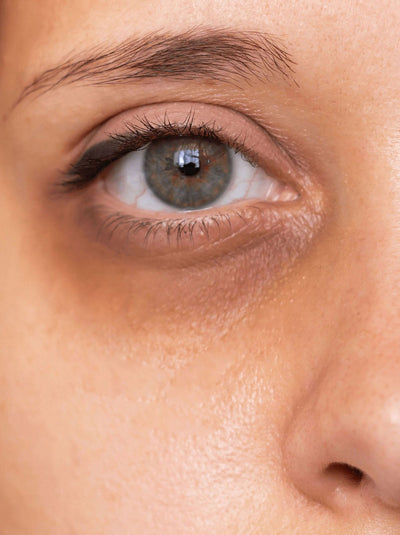 Ojeras oscuras