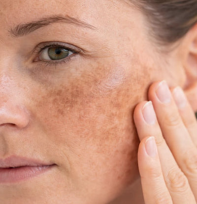 Melasma, Manchas