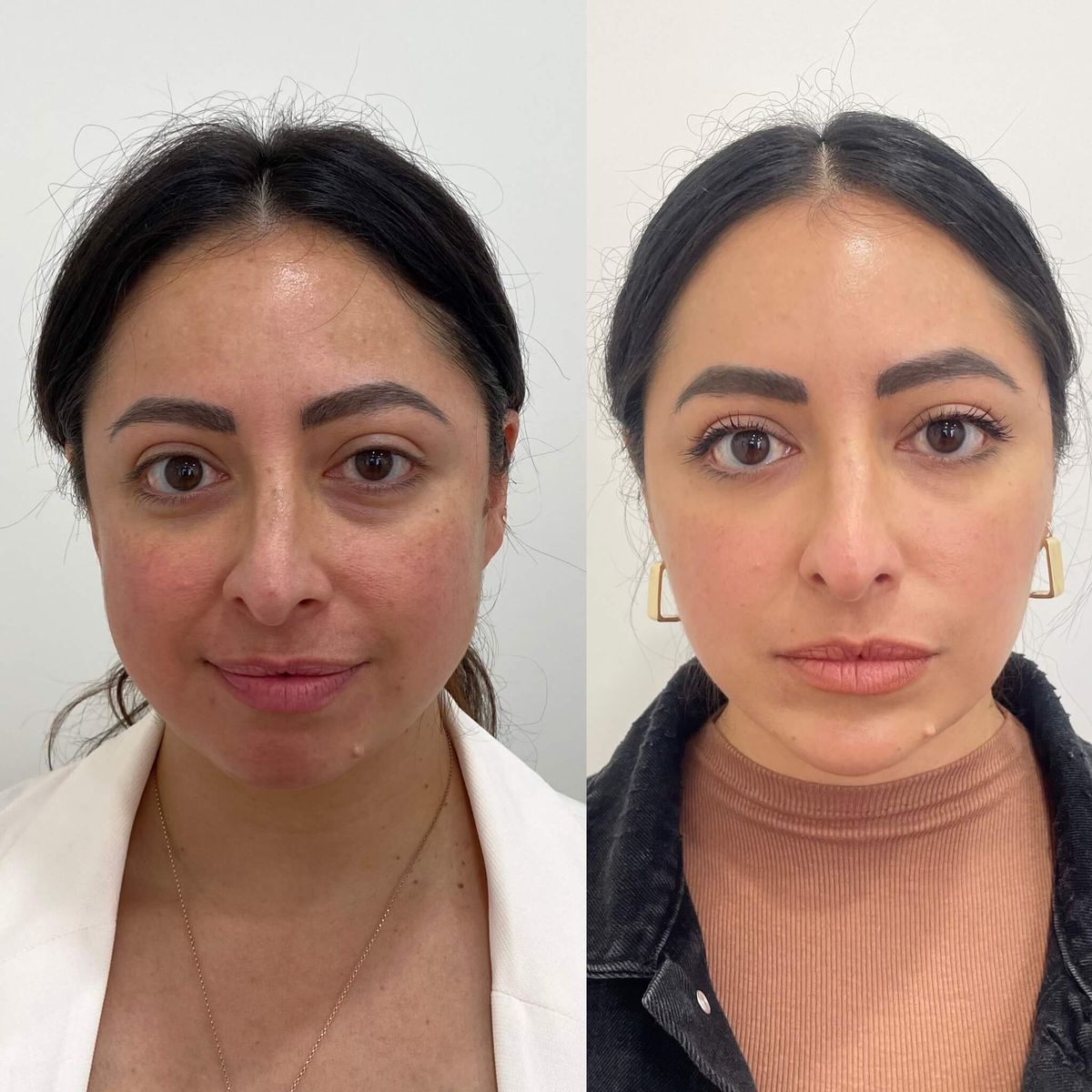 Mascarilla Coreana PDRN ADN Salmón