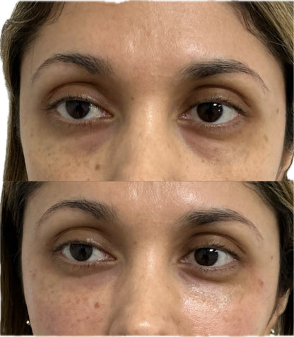 Parches Oculares de Colágeno y Péptido PDRN