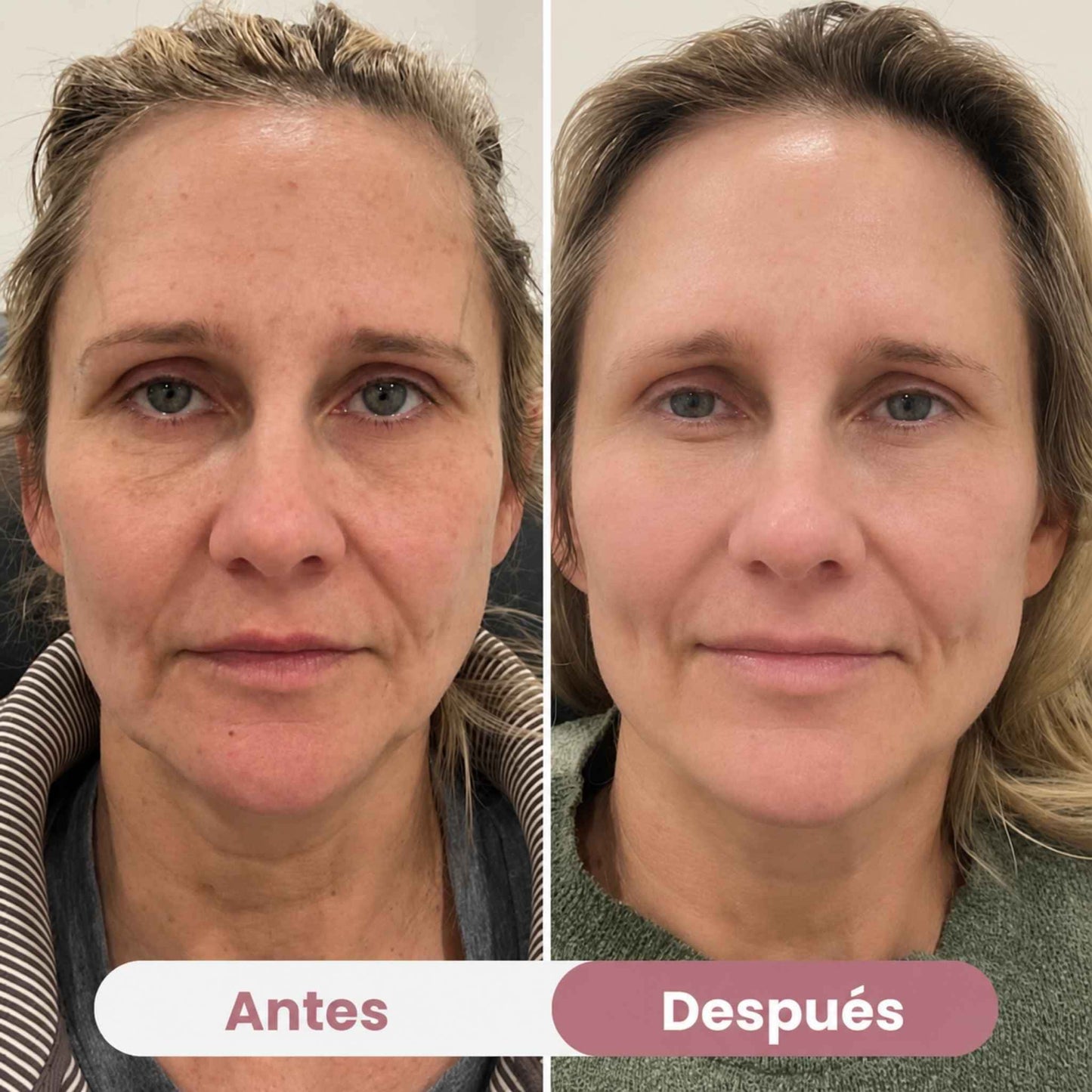Mascarilla Ocular de Colágeno Peptidico | Anti-ojeras