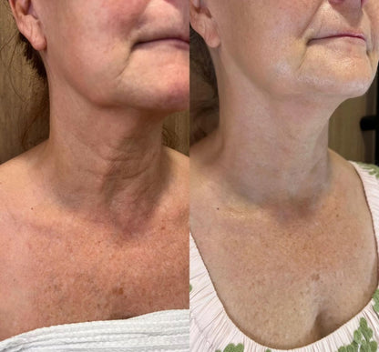 Crema de Colágeno para el Cuello PDRN con Masajeador